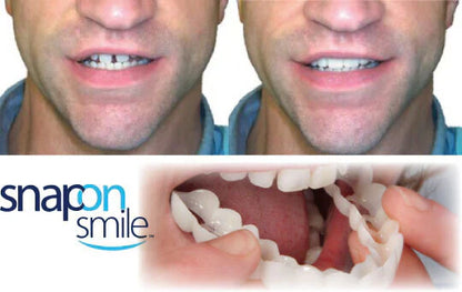 Sonrisa Perfecta con Carillas Dentales